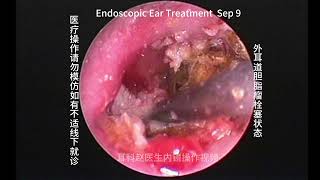 Embolization status of external auditory canal cholesteatoma [upl. by Euell]