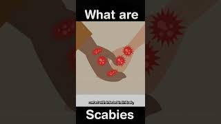 What are Scabies [upl. by Nyrok901]