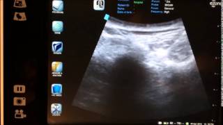 ultrasound guided bilateral SI joint injection  sacroilliac joint injection [upl. by Nowujalo]