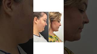 Drastic Plastic Surgery Transformation Insane Necklift Results 🤯 [upl. by Ihtak]