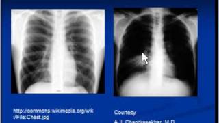 Chest xray interpretation  Lung consolidation and main causes [upl. by Alitha6]