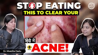 How to get rid of Acne  Acne Treatment  Acne hone par kya khana chahiye  Dr Nivedita Dadu [upl. by Alby]