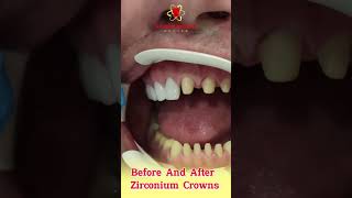 Before and After Zirconium Crowns dentist dental [upl. by Dex]