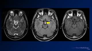 Neuroradiology board review 3 case 6 [upl. by Nanete]