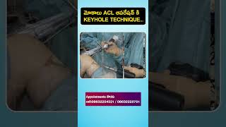 Knee pain amp instability  ACL tear surgery  New technique with keyhole Arthroscopy shorts acl [upl. by Eneleuqcaj]