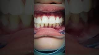 Diastema closure Dokter Gigi Cuspaeni dentalcare doktergigi veneers foryou fyp trending jjj [upl. by Daniyal133]