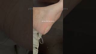 pov you waited too long for that pedicure 😬 pedicure callusremoval [upl. by Gayl]