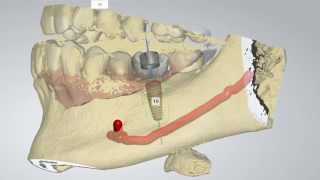 Digital Implant Dentistry [upl. by Anirahs]