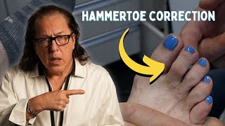 Hammertoe Correction Without Invasive Surgery [upl. by Yemar]