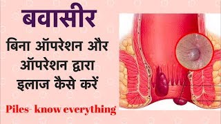 बवासीर  बिना ऑपरेशन और ऑपरेशन द्वारा इलाज कैसे करें  Piles  Hemorrhoids [upl. by Udella158]