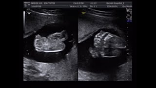 fetal ultrasound of 20 weeks 21 weeks baby boy moving [upl. by Valaria]