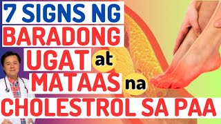 7 Signs ng Baradong Ugat at Mataas na Cholesterol sa Paa  By Doc Willie Ong [upl. by Bbor]