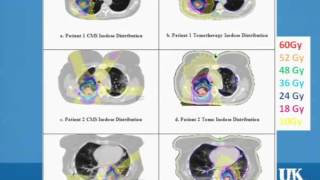 SBRT Treatment Plans vs Tomotherapy [upl. by Nemrak290]