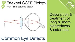 Edexcel GCSE Biology  Eye defects and their correction [upl. by Zetnom]