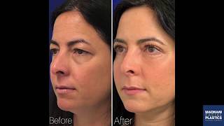 Daily Healing Progress Fat Transfer Upper amp Lower Blepharoplasty Photos [upl. by Atinihc]