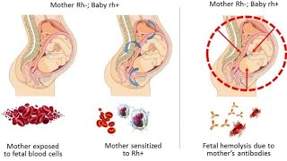 Erythroblastosis fetalis mech life academy narendra sir [upl. by Feodora818]