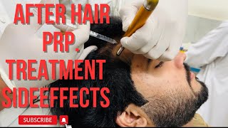 After hair PRP treatment side effects 😰 [upl. by Edlin10]