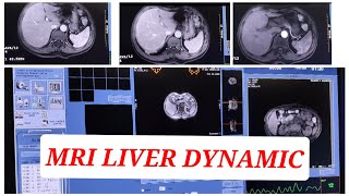 MRI Liver Triphasic  Dynamic Liver [upl. by Gerri]