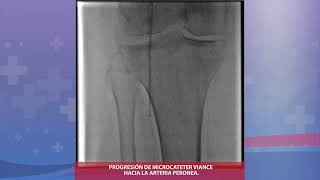 Angioplastia Periferica Compleja [upl. by Ateekahs878]