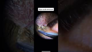 Stye Scab Removal [upl. by Amery]