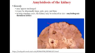 Pathology Lecture  Stromalvascular mesenchymal and mixed degenerations [upl. by Cutcheon77]