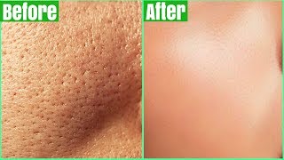 How To Get Rid Of LARGE PORES PERMANENTLY 100 Works Shrink amp Get Clear Glass Skin Naturally [upl. by Karina355]