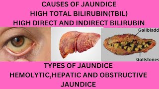 CAUSES OF JAUNDICECAUSES OF HIGH TOTAL BILIRUBINWHY IS MY DIRECT AND INDIRECT BILIRUBIN HIGH [upl. by Yelik]