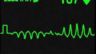 Torsades de Pointes  ECG Simulator  Arrhythmia Simulator [upl. by Sass]