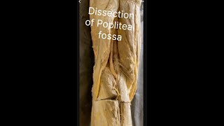 Popliteal fossa Dissection of popliteal fossa Anatomy of popliteal fossa Contents popliteal fossa [upl. by Llenrad]