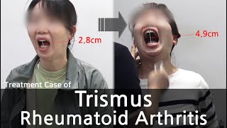 Trismus  Rheumatoid Arthritis  개구장애  류마티스 관절염 치료사례 [upl. by Aiveneg909]