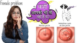 What is Nabothian cysts   Causes  Symptoms  Treatment  By Dr Vanshika saxena [upl. by Lisbeth]