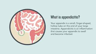 Appendicitis Symptoms Causes Diagnosis and Treatment  Merck Manual Consumer Version [upl. by Ivah758]