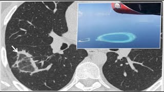 chestradiology signs🛑 1Chest imaging using signs symbols and naturalistic images [upl. by Iznil123]