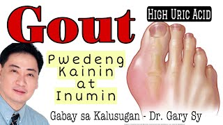 GOUT PWEDENG Kainin at Inumin  Dr Gary Sy [upl. by Banks]