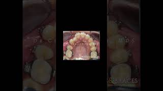 Braces treatment timelapse 2 dentist bracing smile orthodontist mtbraces dentalclinic bracket [upl. by Kenti819]