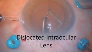 Dislocated Intraocular Lens  Cataract Complications [upl. by Jeanelle]