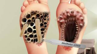 ASMR FOOT TREATMENT ANIMATIONS Animation of deep cleaning of a mans foot [upl. by Hennahane]