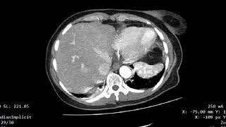 CASE 947 CT AORTOGRAPHY DISSECTING THORACIC AORTIC ANEURYSM [upl. by Ezarra]