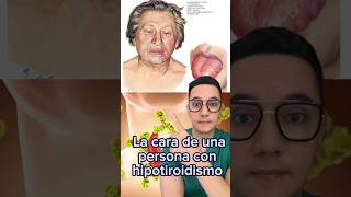 Así puede ser la cara de un paciente con hipotiroidismo  Dr William Guerrero medicina shorts [upl. by Assirahc]