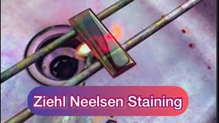 Ziehl Neelsen stainingZN stainingAFB staining Afb tb znstain [upl. by Enyad]