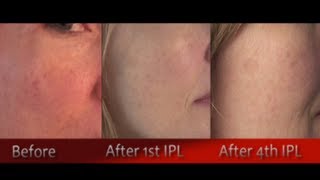 IPL Photofacial Review After 4 Treatments  Before amp After [upl. by Nnainot]