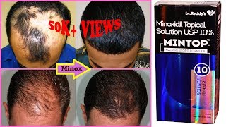 Minoxidil Mintop 10  Product Review [upl. by Ettelorahc]