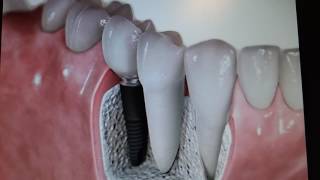 Perno corona o implante dental [upl. by Aticilef]