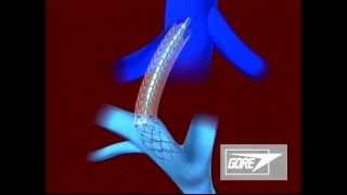 Endoprosthesis  Transjugular Intrahepatic Portosystemic Shunt TIPS [upl. by Ilke]