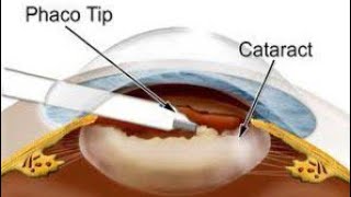 Phacoemulsification for Cataract  All you want to know about cataract surgery [upl. by Dann]