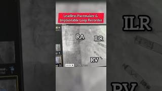 Leadless Pacemaker amp Implantable Loop Recorder on fluoroscopy heart Cardiology [upl. by Gennaro7]