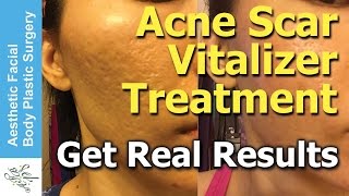 Treat All Types of Acne Scars in One Treatment in 2 Hours with the New Acne Scar Vitalizer Treatment [upl. by Klepac665]