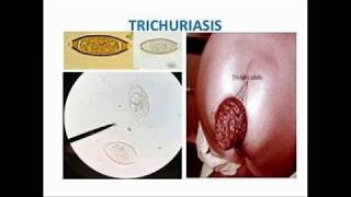 Trichuris trichiura morphology life cycle pathogenesis diagnosis and treatment [upl. by Yarahs]