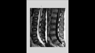 Videoaula e dicas em radiologia T1 e T2 na ressonância magnética RM da Coluna vertebral [upl. by Eleanor291]