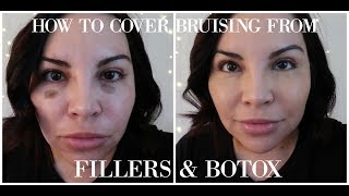 HOW TO COVER BRUISING FROM FILLERS amp BOTOX [upl. by Pasadis]